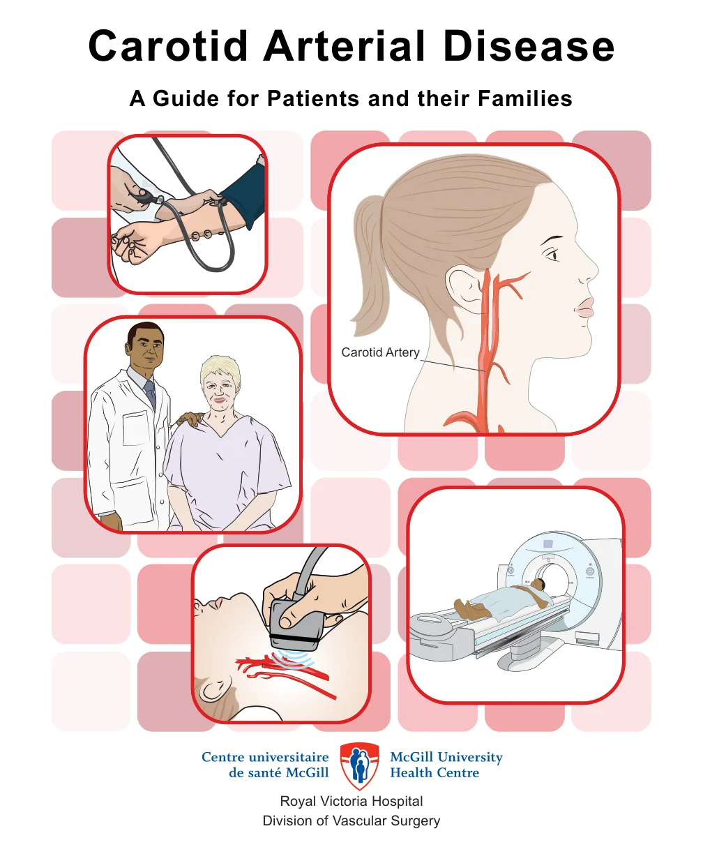 Carotid Artery Surgery