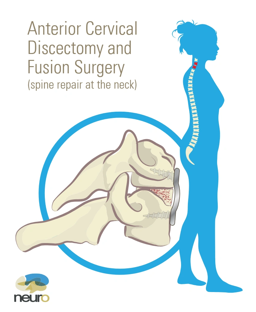 Anterior discectomy and fusion surgery